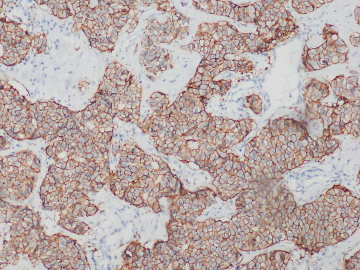 乳腺-免疫组化.jpg 乳腺-免疫组化.jpg