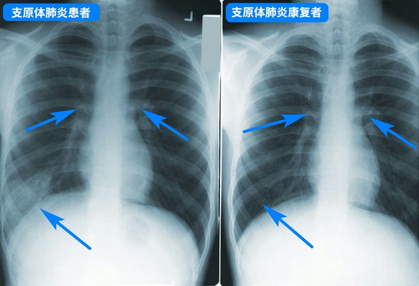 03_支原体肺炎.jpg 03_支原体肺炎.jpg